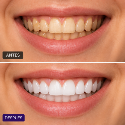 V34 Smile Glow | Blanco Instantáneo y Brillo Natural